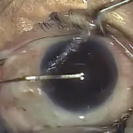 So Then, How Is Cataract Surgery Done? (post 6 of 9)