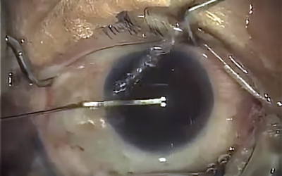 So Then, How Is Cataract Surgery Done? (post 6 of 9)