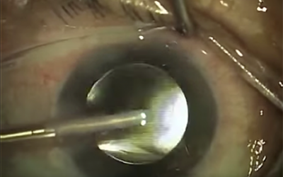 So Then, How Is Cataract Surgery Done? (post 7 of 9)