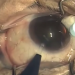 So Then, How Is Cataract Surgery Done? (Post 5 of 9)