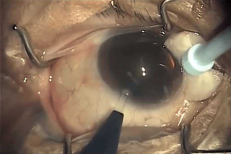 How is Cataract Surgery done clear cornea temporal incision