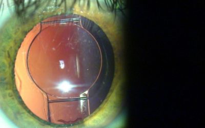 14 Reasons Why You Want Your Surgeon to “Clean Up” After Cataract Removal