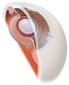 Single-stitch-surgery-cataract