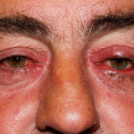 The Link Between Ocular Rosacea and Parkinson’s – Are You at Risk?