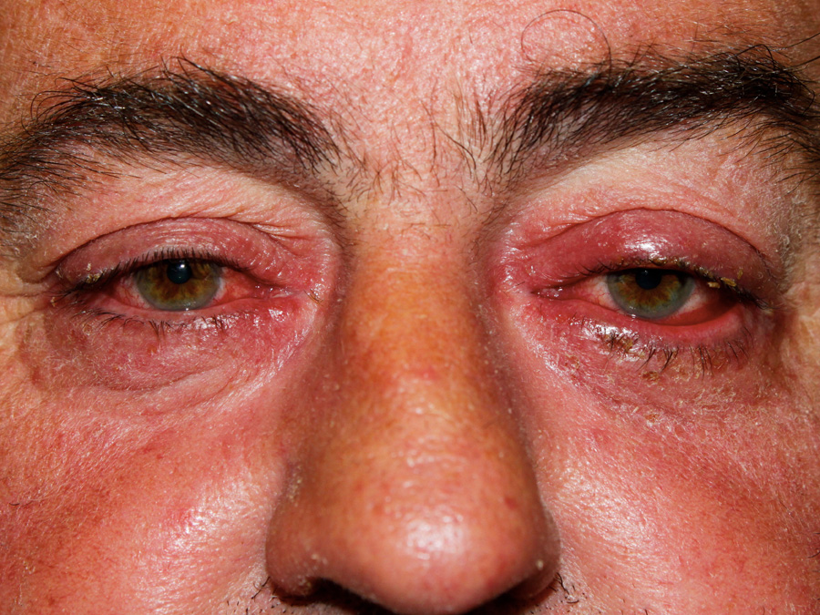 What Is Ocular Rosacea? - WebMD